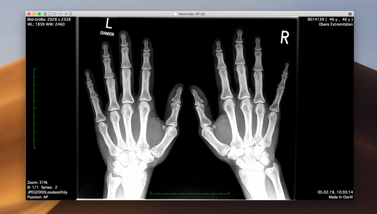 osirix lite md